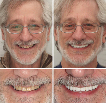 Custom-SET Functional Dentures