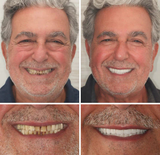 Custom-SET Functional Dentures